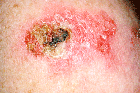 Round Patch Of Dry Skin On Chest